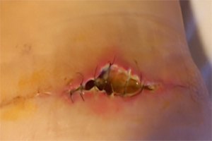 Deiscência de sutura